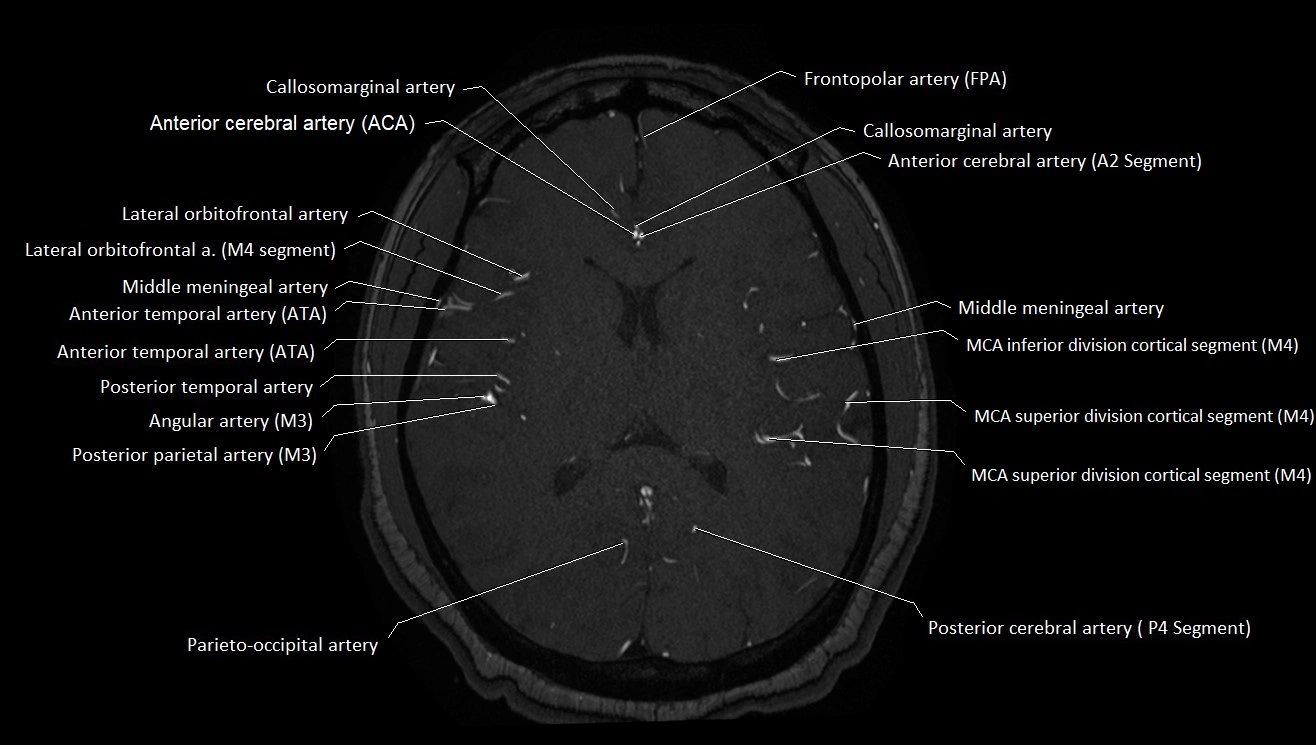 MRA brain (cerebral arteries) anatomy axial 3T image 32.webp